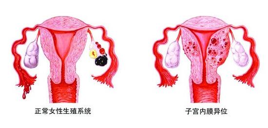 造成子宫内膜异位症的病因有哪些