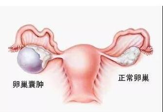 分析卵巢性不孕的症状