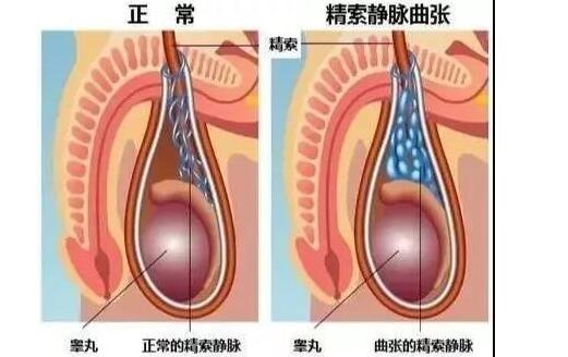男人出现精索静脉曲张有哪些危害