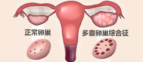 患上多囊卵巢综合症有哪些症状