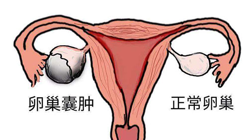 卵巢囊肿的症状